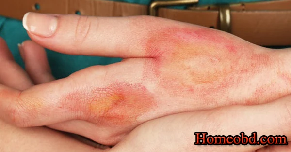 আগুনে পোড়া