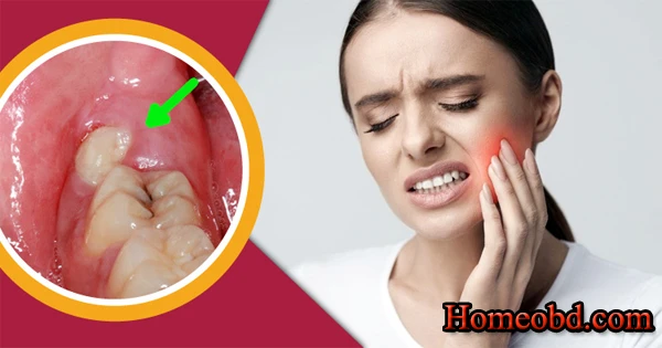 আক্কেল দাঁত