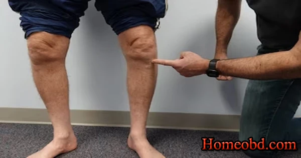 আর্থ্রাইটিস