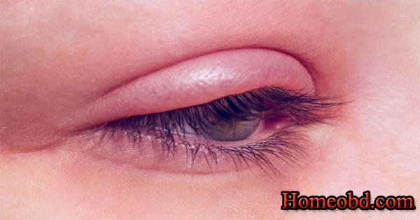 চোখ ফোলা