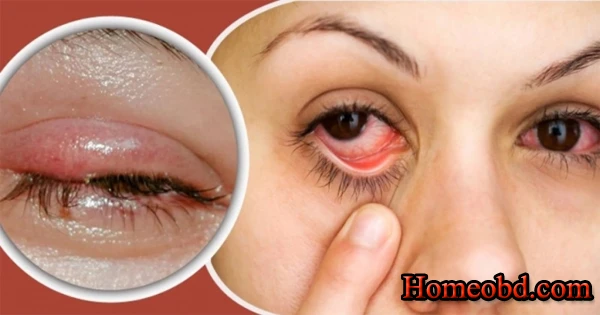 চোখের বিভিন্ন সমস্যা