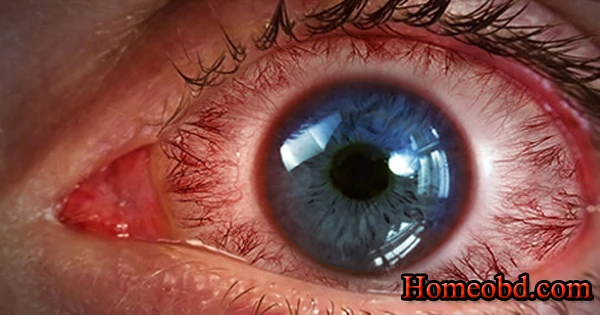 চোখের কাল শিরা