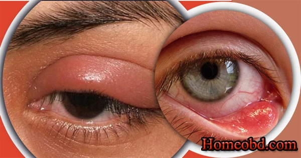 চোখের পাতার পক্ষাঘাত ও চুলকানি