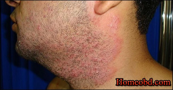 চর্মরোগ