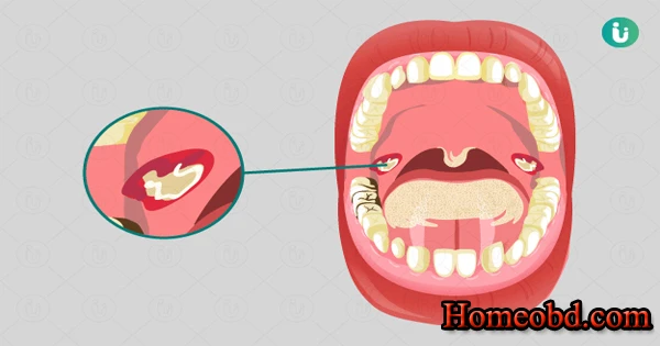 ডিপথেরিয়ার কুফল
