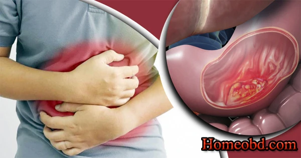 ডিউডিন্যাল আলসার