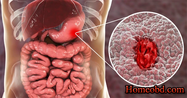 গ্যাসষ্ট্রিক আলসার