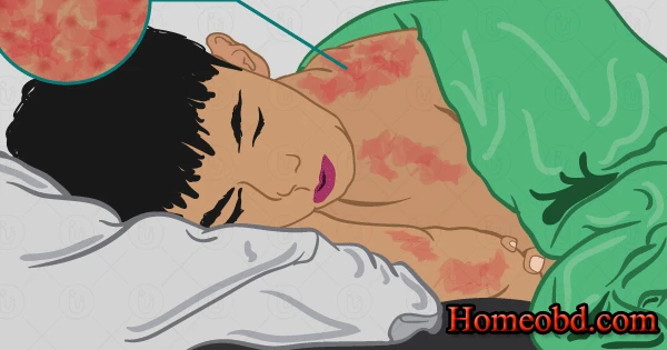 হাম জ্বর