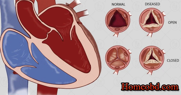 হার্টের ভাল্বের রোগ