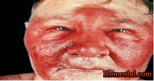 ইরিসিপেলাস/ বিসর্প