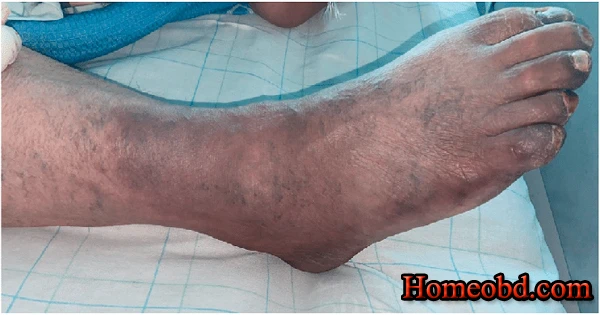 ইস্কেমিয়া