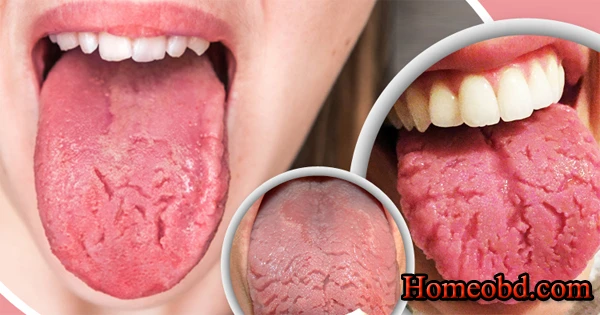 জিহ্বা ফাটা