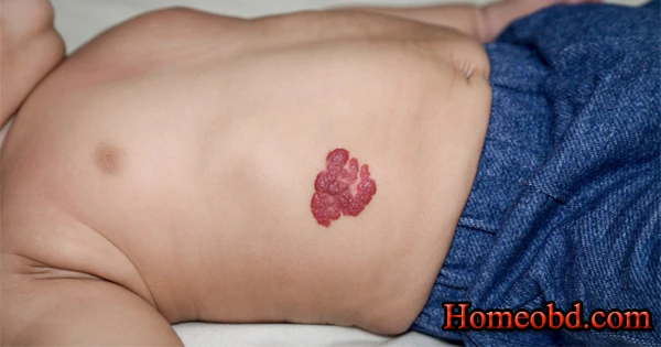 জন্ম দাগ