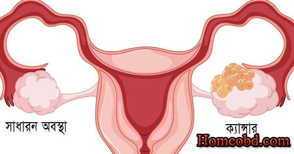 জরায়ু ক্যানসার