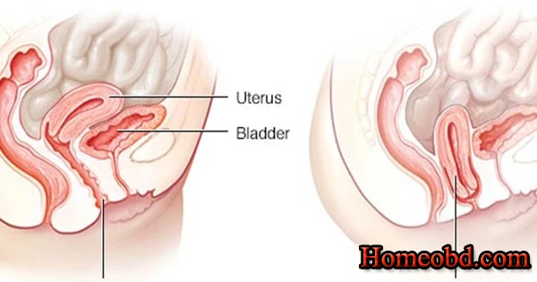 জরায়ুর স্থানচ্যুতি