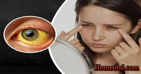 কামলা/হলদে(Jaundice)