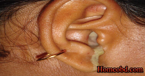 কান পাকা