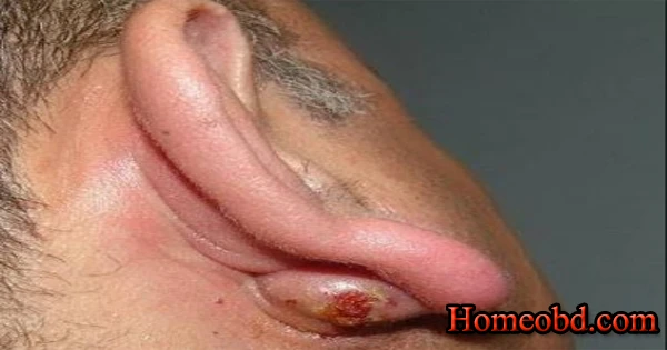 কানের ফোঁড়া