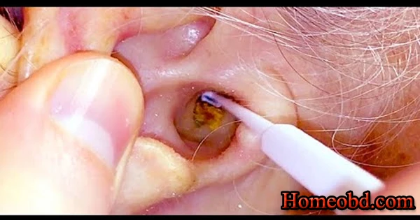 কানের   ভিতর খোল বা মল