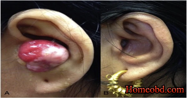 কানের ভিতর পলিপ