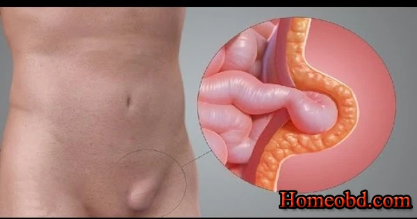 কুঁচকি প্রদাহ