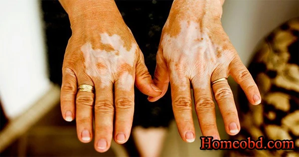 কুষ্ঠ ব্যাধি