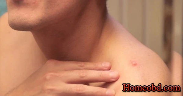 মাংসপেশীতে ফোঁড়া