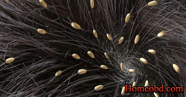 মাথার উকুন