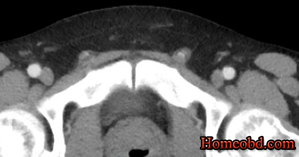 মলত্যগ কালে শুক্রপাত