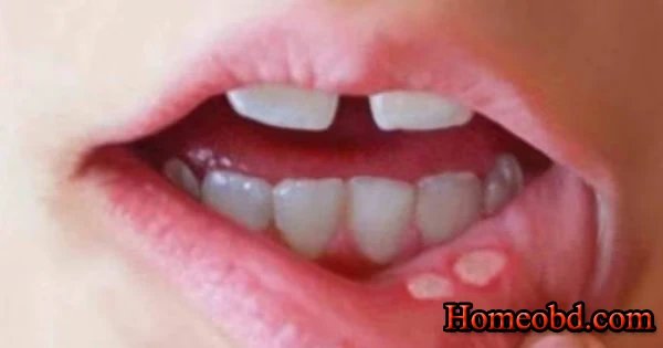 মুখে ক্ষত