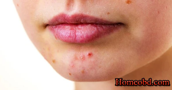 মুখমন্ডলের সমস্যায়