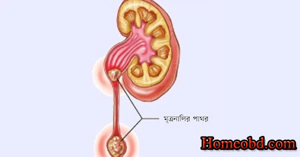 মূত্র পাথুরি