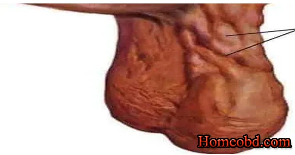 অন্ডকোষের বিবৃদ্ধি/ স্ফীতি