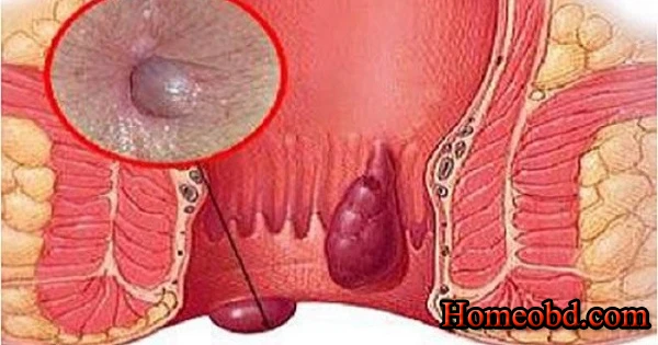 অর্শ (Piles)