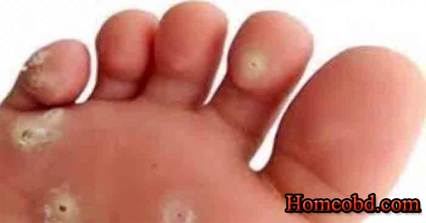 পায়ের কড়া