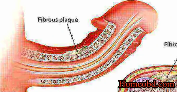 পুরুষাঙ্গ বেঁকে যাওয়া