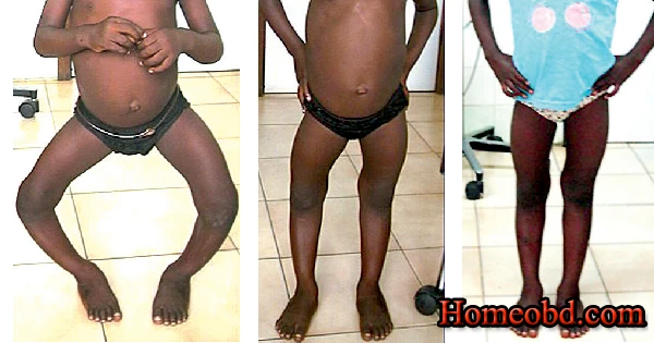 রিকেট দোষ