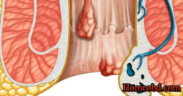 রক্তস্রাবী অর্শ