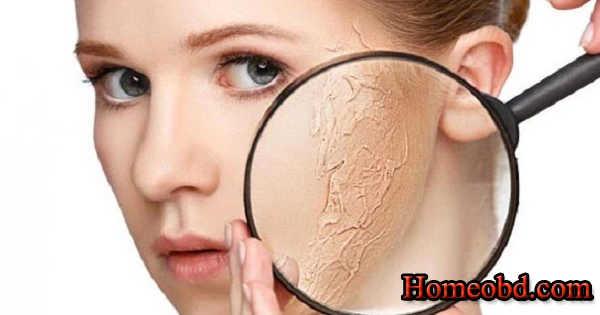 শীত ফাটা