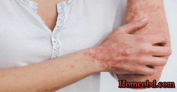 সিজনেল চর্মরোগ