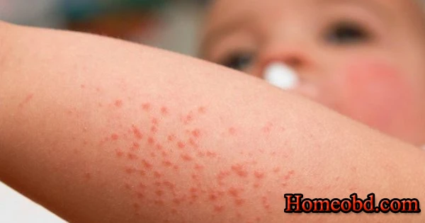 শিশুর চুলকানি