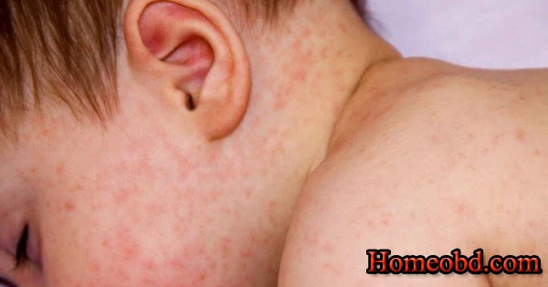 শিশুর ঘামাচি