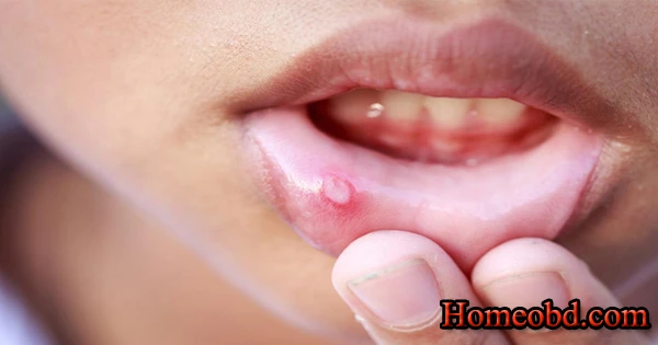 শিশুর মুখে ঘা