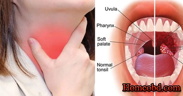 শিশুর টনসিল