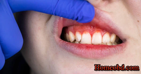 স্কার্ভি রোগ