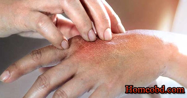 সোরিয়েসিস