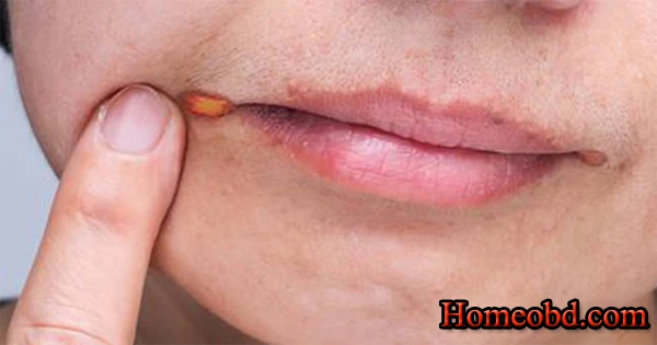 ঠোঁটের কোণে ঘা/ফাটা